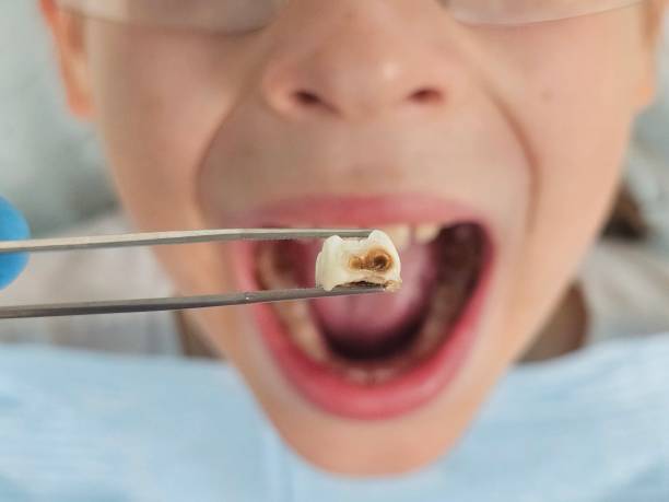 Best Emergency Dental Care for Broken or Chipped Teeth in West Falls Church, VA